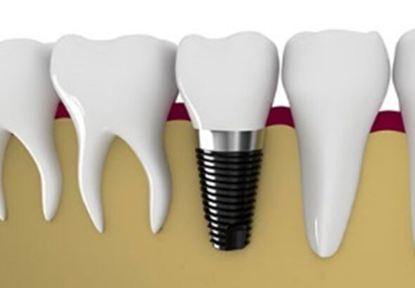 آیا ایمپلنت فوری با تراکم استخوان کم امکان دارد؟