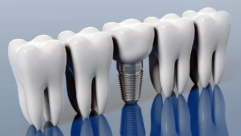 ۲. تراکم کافی استخوان فک و اهمیت آن در ایمپلنت فوری در تهران